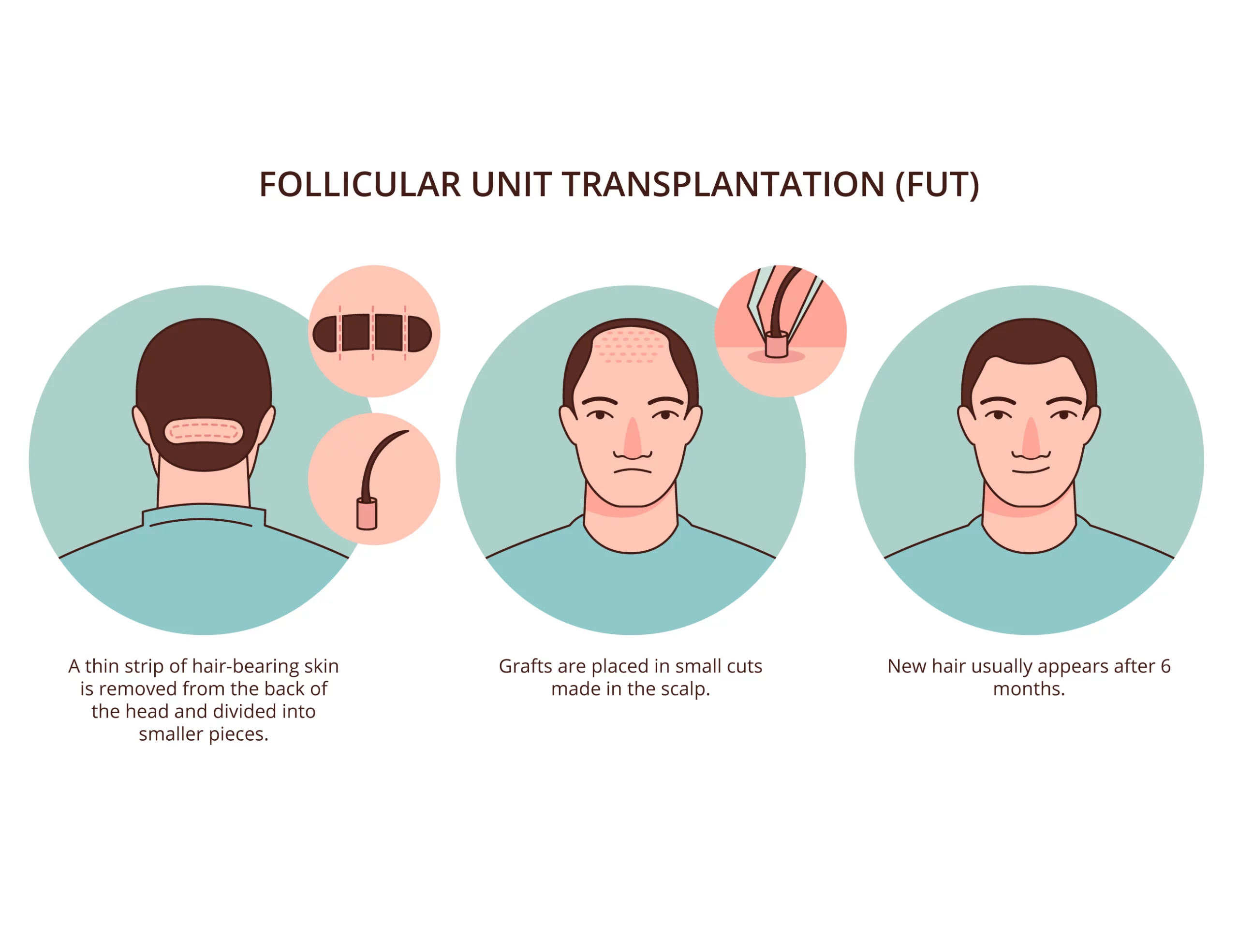 Follicular Unit Transplantation Process