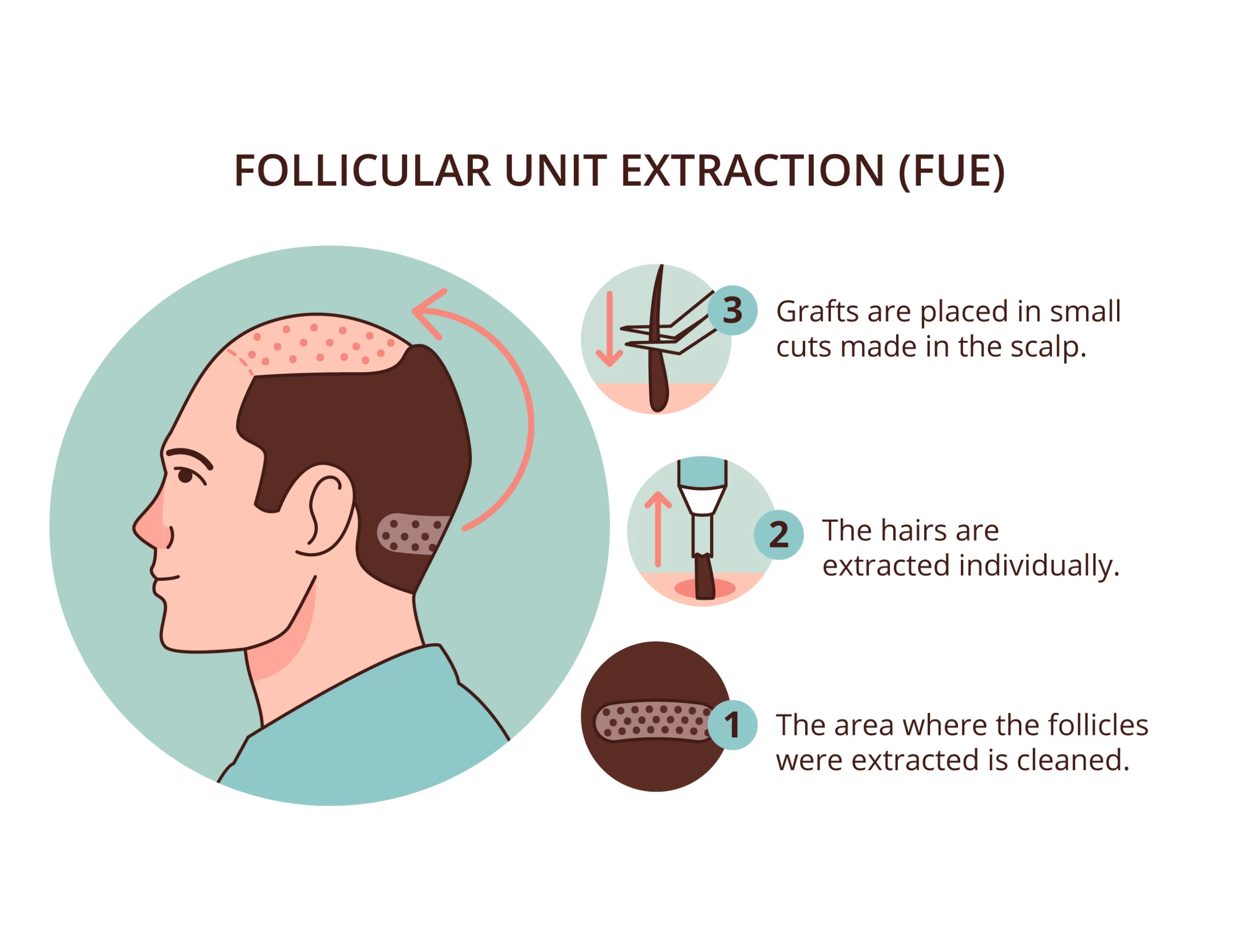 Follicular Unit Extraction procedure for hair restoration