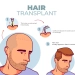 Hair Transplant Treatment