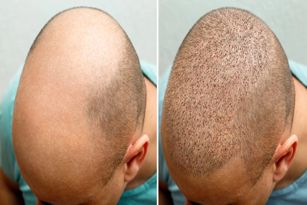 Man's Head before and after hair transplant 