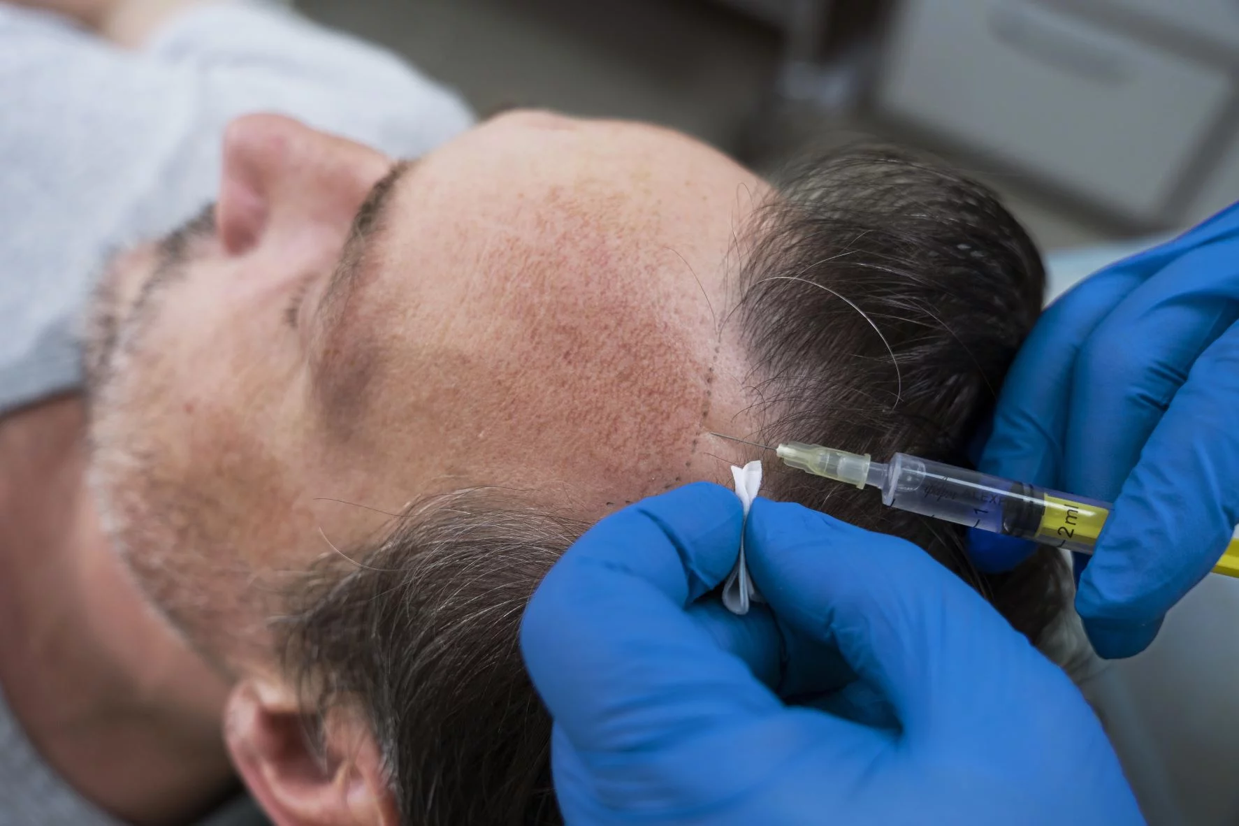 men getting hair transplant treatment 